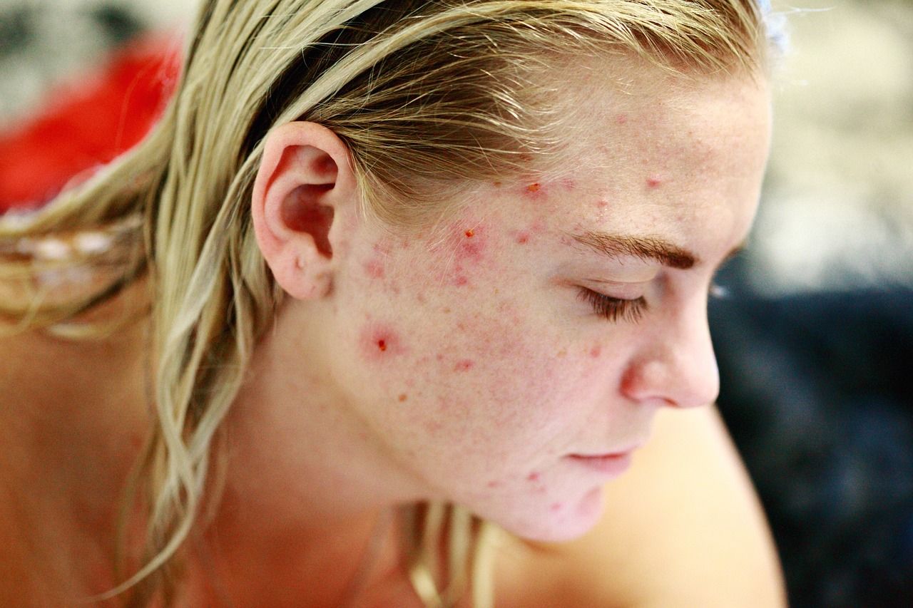 liste complète de quels sont les traitements possibles contre l'acné pour s'en débarrasser